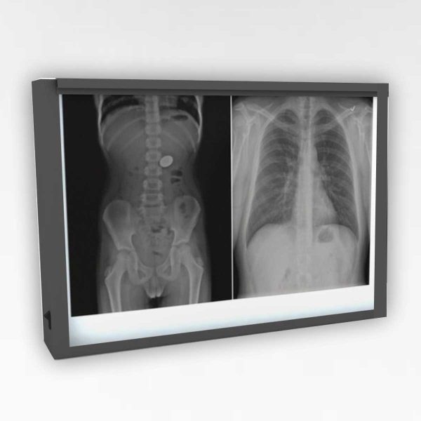 Double X ray Viewing