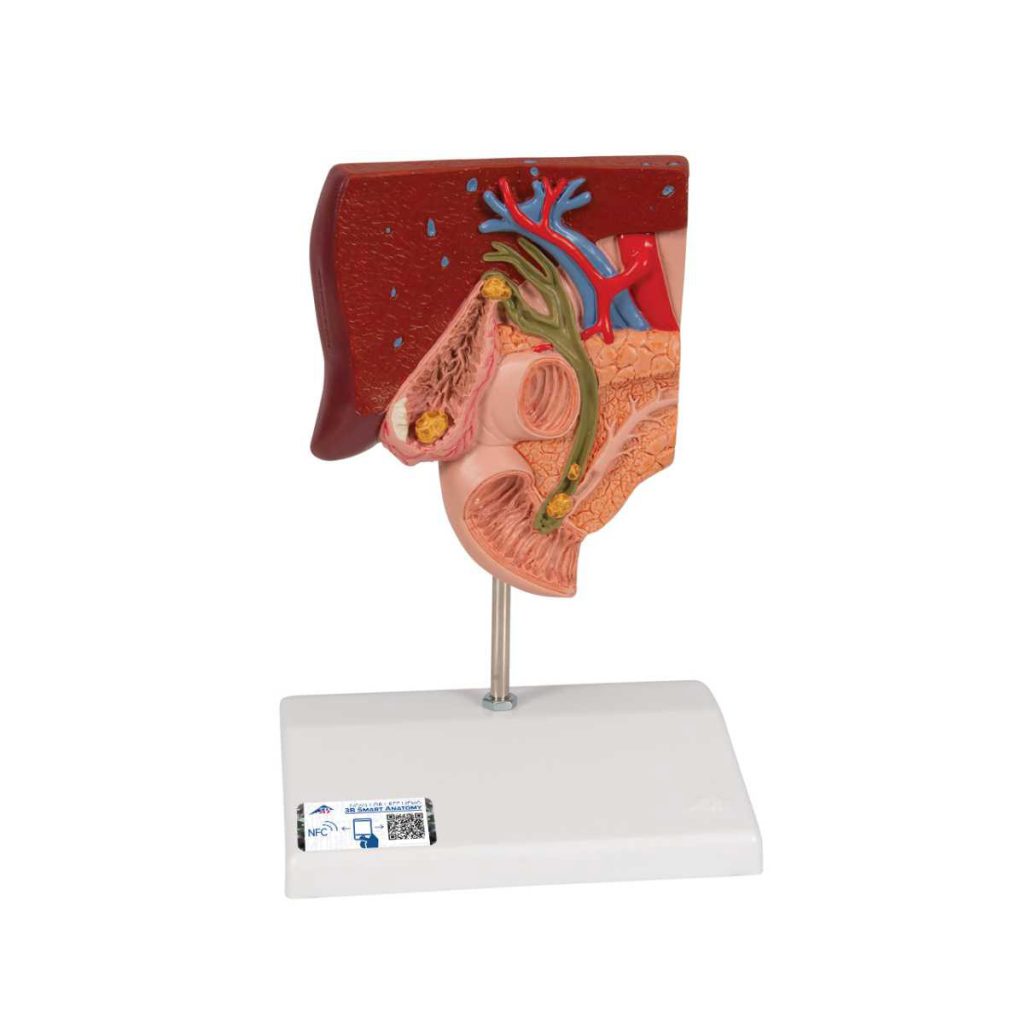 3B Scientific Gallstone Model – 3B Smart Anatomy - Medical Grade Professional (Healthcare)