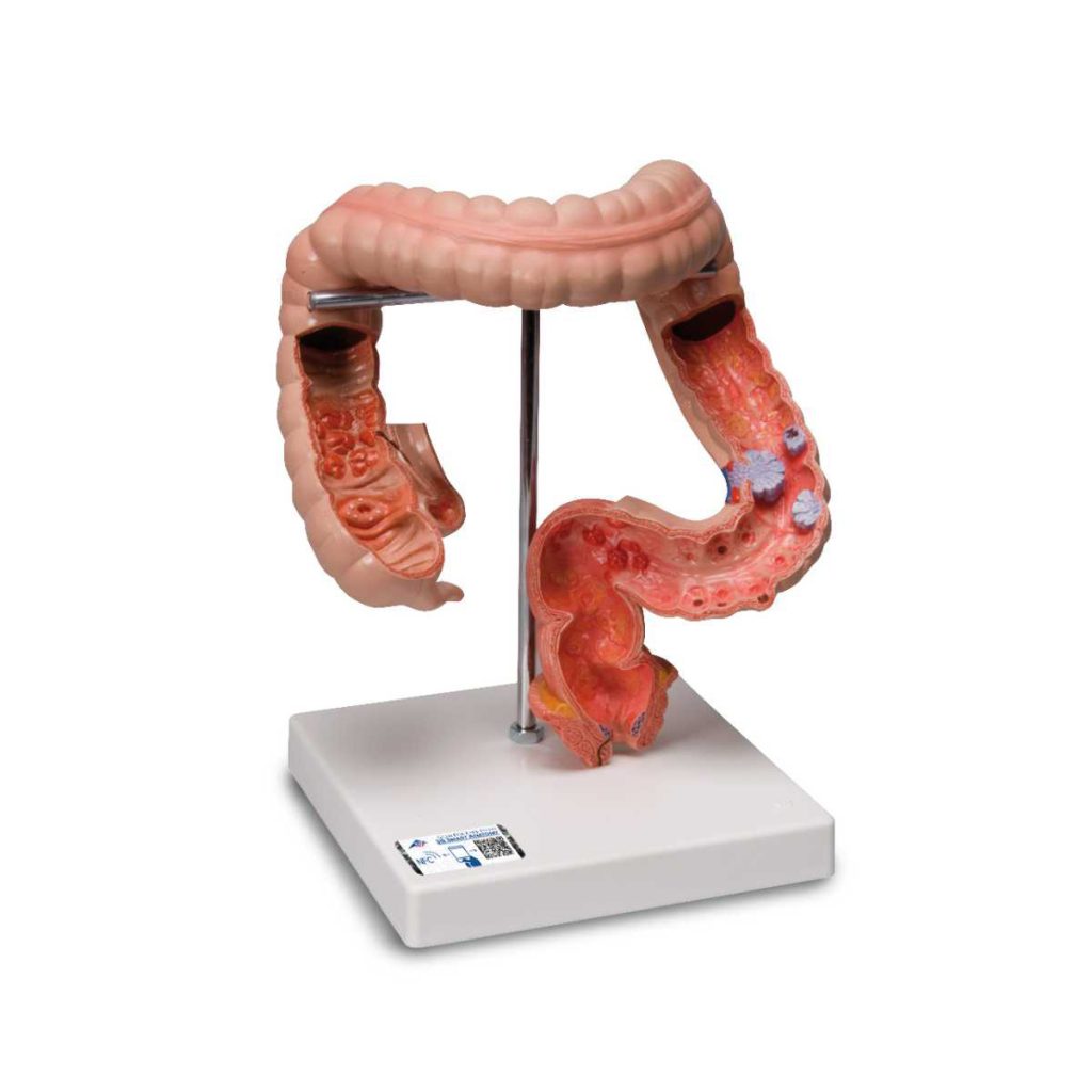 3B Scientific Intestinal Diseases Model - Medical Grade Professional (Healthcare)