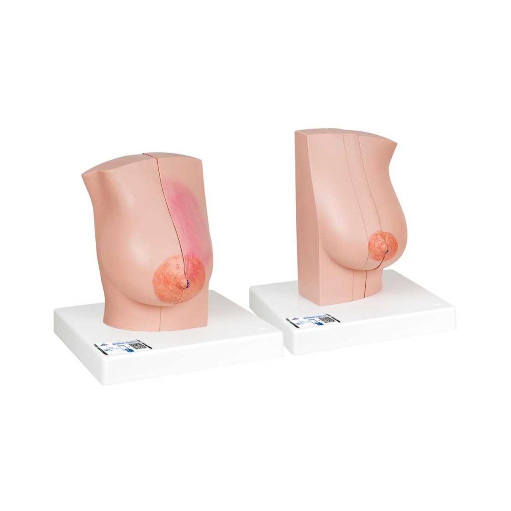 3B Scientific Model of Female Breast with Healthy and Unhealthy Tissue – 3B Smart Anatomy - Medical Grade Professional (Healthcare)