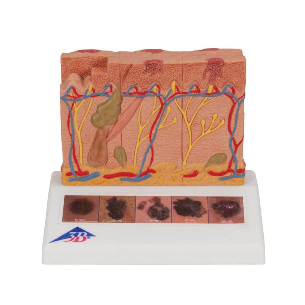 3B Scientific Skin Cancer Model with 5 stages, 8 times magnified – 3B Smart Anatomy - Medical Grade Professional (Healthcare)